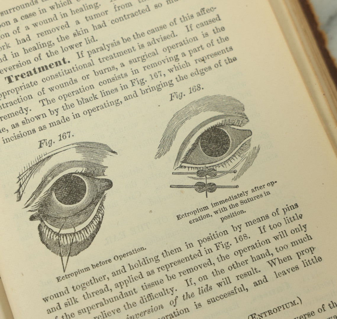 Lot 122 - "The People's Common Sense Medical Adviser In Plain English, Or, Medicine Simplified" Antique Illustrated Medical Book By R.V. Pierce, M.D., Twelfth Revised Edition, Buffalo, New York, 1883