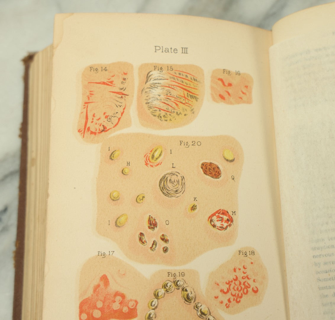 Lot 122 - "The People's Common Sense Medical Adviser In Plain English, Or, Medicine Simplified" Antique Illustrated Medical Book By R.V. Pierce, M.D., Twelfth Revised Edition, Buffalo, New York, 1883