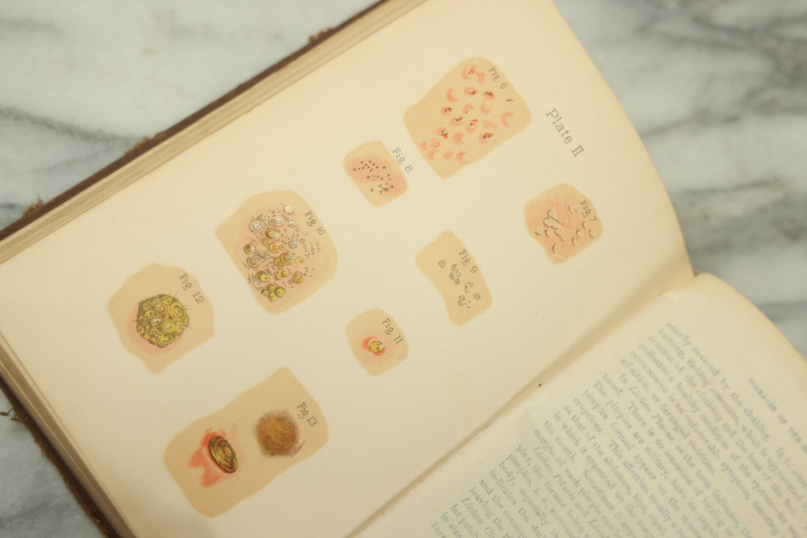 Lot 122 - "The People's Common Sense Medical Adviser In Plain English, Or, Medicine Simplified" Antique Illustrated Medical Book By R.V. Pierce, M.D., Twelfth Revised Edition, Buffalo, New York, 1883