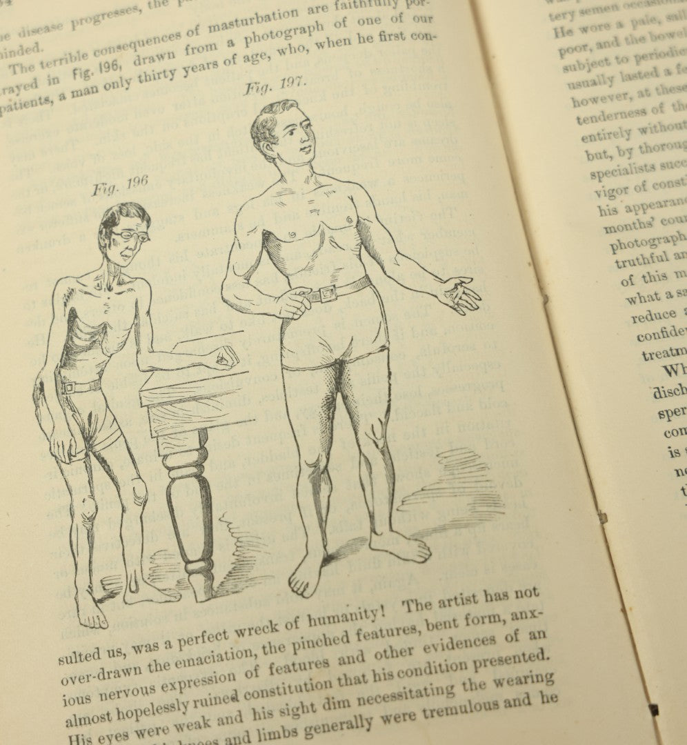Lot 122 - "The People's Common Sense Medical Adviser In Plain English, Or, Medicine Simplified" Antique Illustrated Medical Book By R.V. Pierce, M.D., Twelfth Revised Edition, Buffalo, New York, 1883