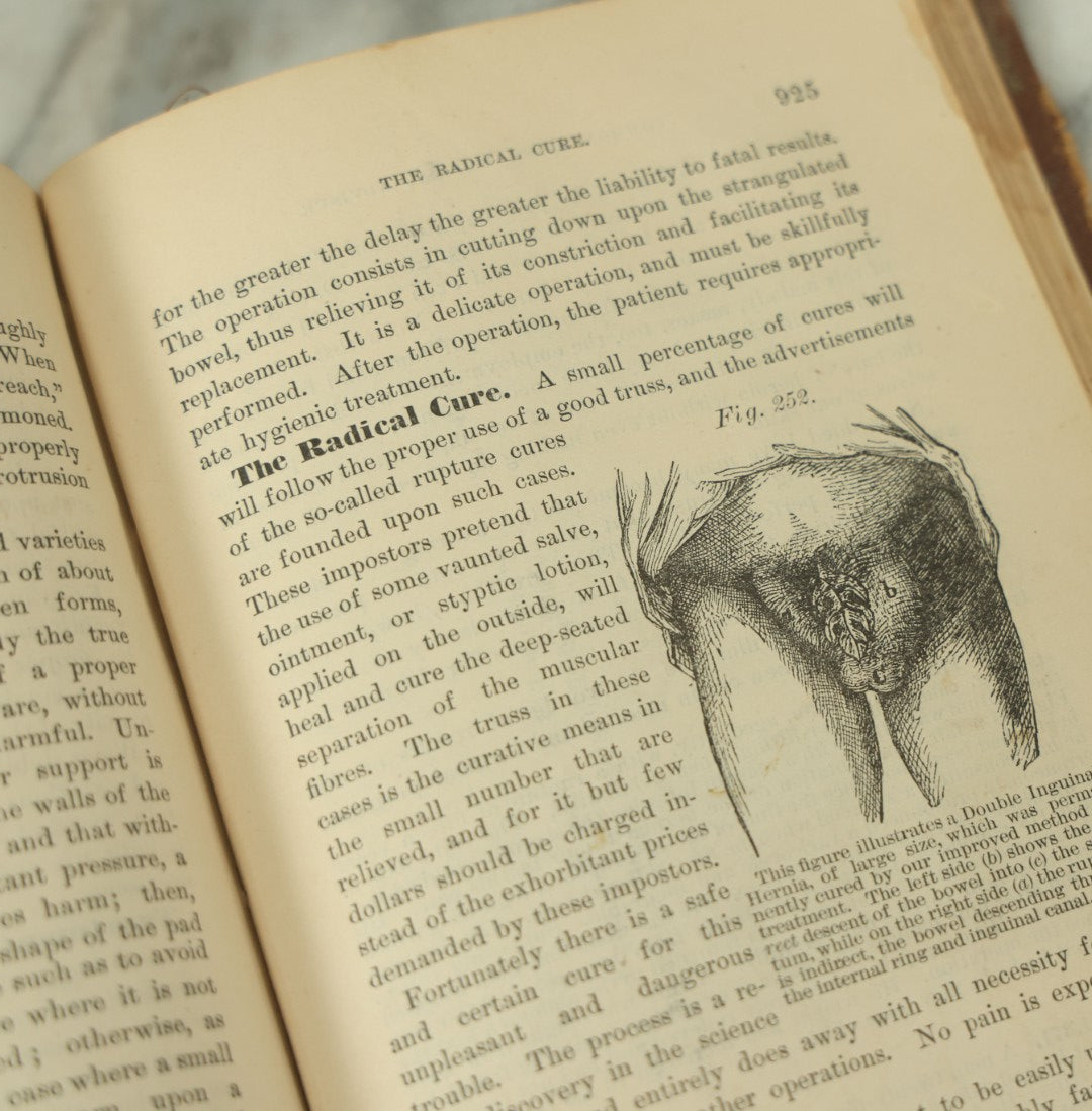 Lot 122 - "The People's Common Sense Medical Adviser In Plain English, Or, Medicine Simplified" Antique Illustrated Medical Book By R.V. Pierce, M.D., Twelfth Revised Edition, Buffalo, New York, 1883