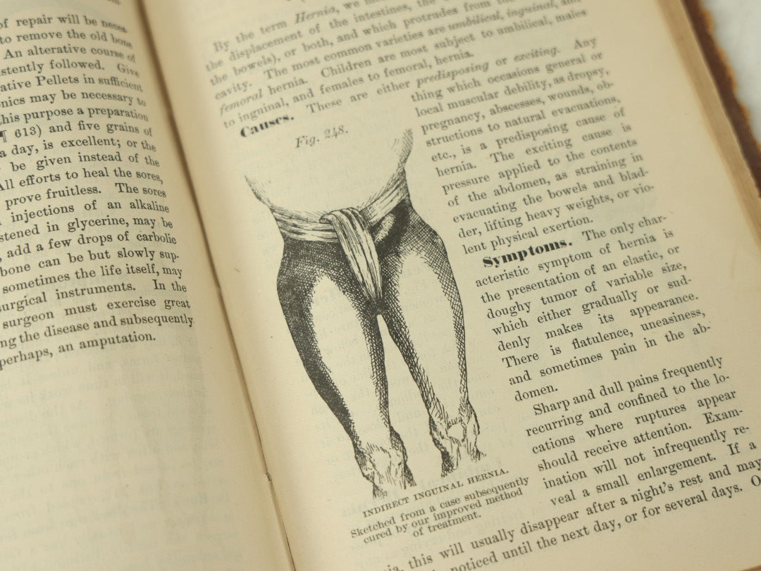 Lot 122 - "The People's Common Sense Medical Adviser In Plain English, Or, Medicine Simplified" Antique Illustrated Medical Book By R.V. Pierce, M.D., Twelfth Revised Edition, Buffalo, New York, 1883