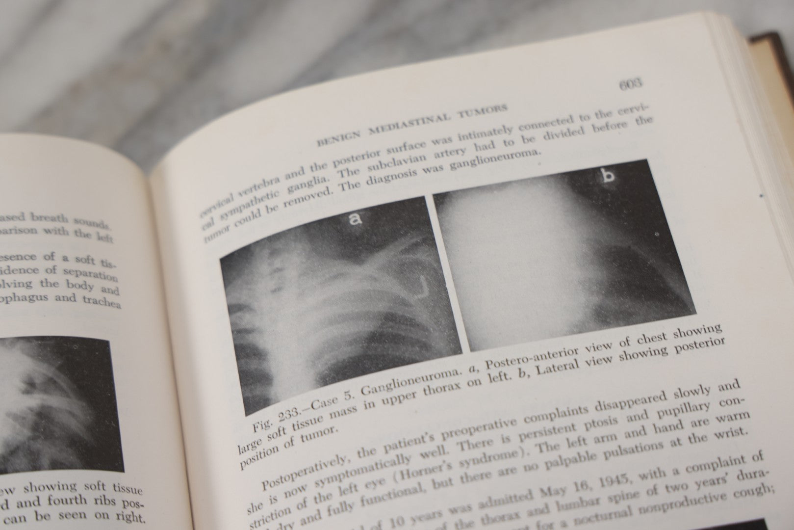 Lot 110 - "The Surgical Clinics Of North America, June 1947, Tumors" Vintage Medical Book With Photographs Of Pathology, W.B. Sauders Company Publishers, 1947