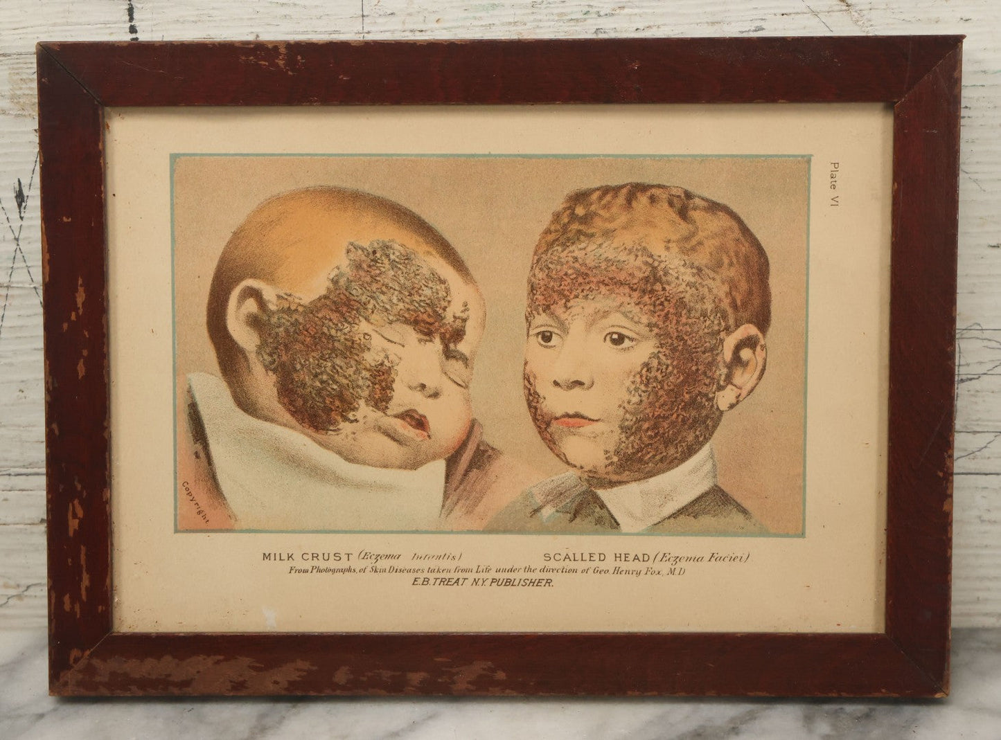 Lot 065 - Antique Skin Condition Medical Print, Milk Crust & Scaled Head, From Photographs Of Skin Diseases Under The Direction Of George Henry Fox, M.D., Published By E.B. Treat, New York, In Custom Frame, 10-7/8" x 7-7/8"