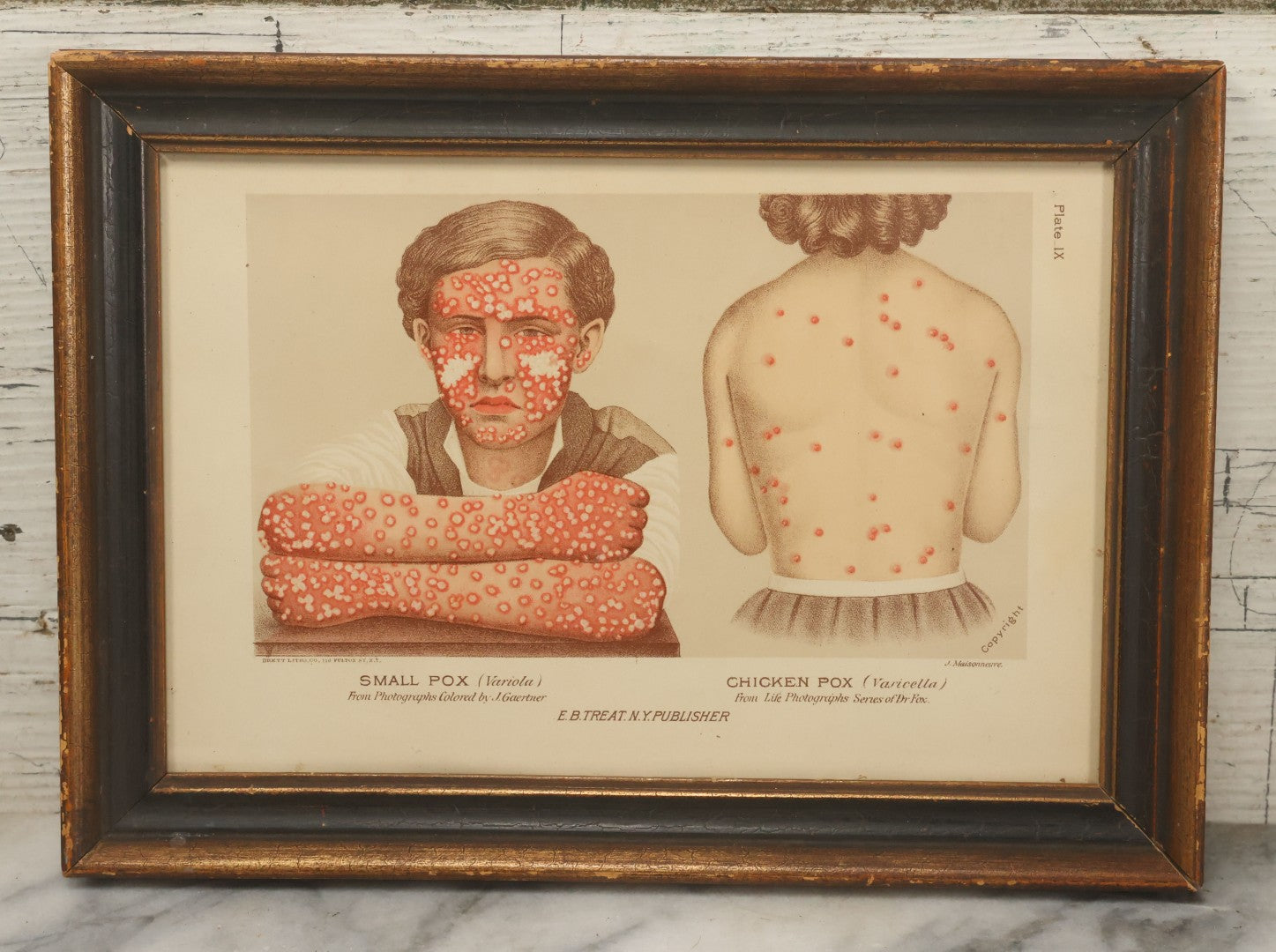 Lot 067 - Antique Skin Condition Medical Print, Small Pox & Chicken Pox, From Photographs Of Skin Diseases Under The Direction Of George Henry Fox, M.D., Published By E.B. Treat, New York, In Custom Frame, 11-1/8" x 8"
