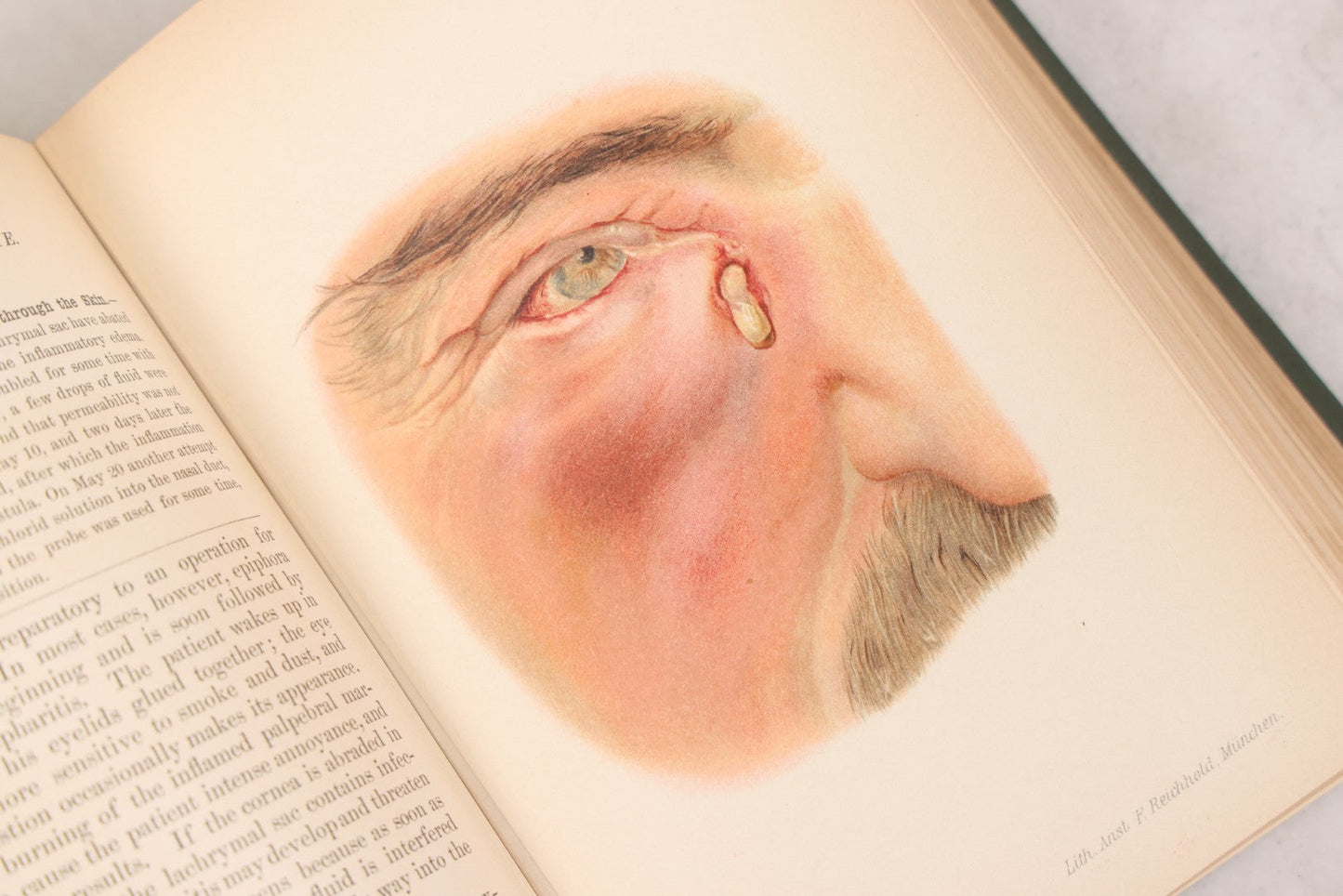 Lot 049 - "Atlas Of The External Diseases Of The Eye Including [...] Pathology And Treatment" Antique Medical Book By Prof. Dr. O. Haab, Translated From German, Illustrated With 76 Plates & 6 Engravings, Published By W.B. Saunders, Philadelphia, 1899
