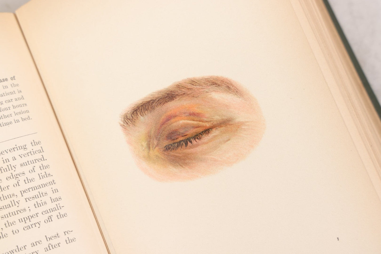Lot 049 - "Atlas Of The External Diseases Of The Eye Including [...] Pathology And Treatment" Antique Medical Book By Prof. Dr. O. Haab, Translated From German, Illustrated With 76 Plates & 6 Engravings, Published By W.B. Saunders, Philadelphia, 1899