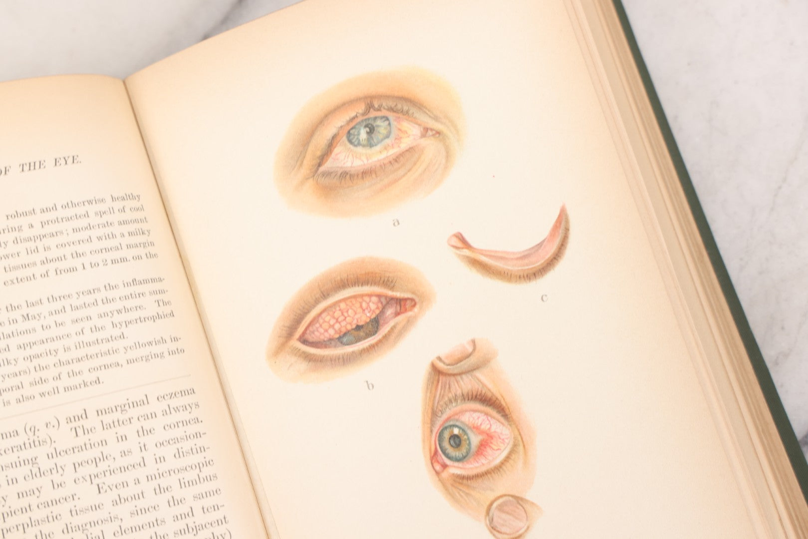 Lot 049 - "Atlas Of The External Diseases Of The Eye Including [...] Pathology And Treatment" Antique Medical Book By Prof. Dr. O. Haab, Translated From German, Illustrated With 76 Plates & 6 Engravings, Published By W.B. Saunders, Philadelphia, 1899