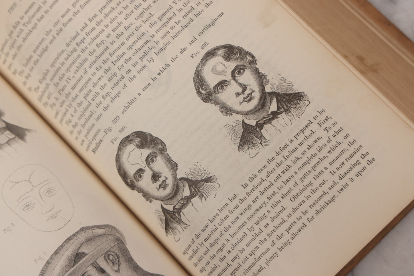 Lot 055 - "A System Of Oral Surgery: Diseases And Surgery Of The Mouth, Jaws, And Associated Parts" Antique Book By James E. Garretson, M.D., Illustrated With Steel Plates And Wood Cuts, 3rd Edition, Published By J.B. Lippincott & Co., Philadelphia, 1881
