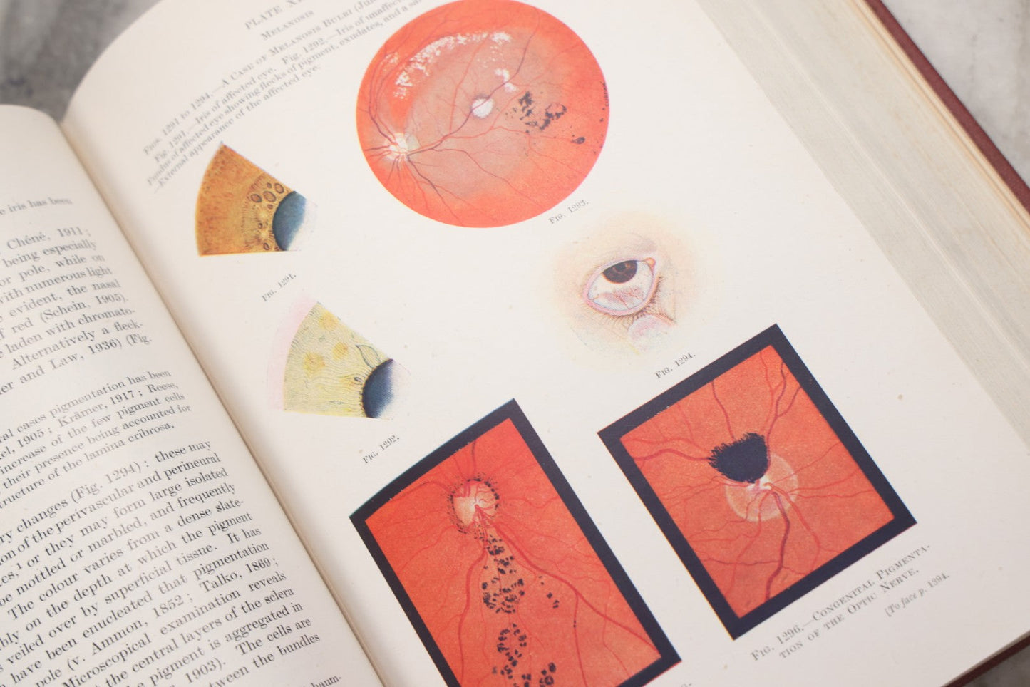 Lot 218 - "Text-Book Of Ophthalmology, Volume II" Vintage Illustrated Medical Reference By Sir W. Stewart Duke-Elder, The C. V. Mosby Company, 1944