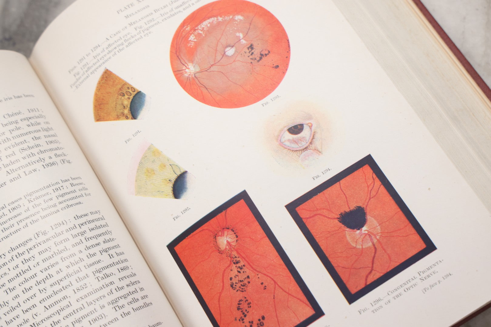 Lot 218 - "Text-Book Of Ophthalmology, Volume II" Vintage Illustrated Medical Reference By Sir W. Stewart Duke-Elder, The C. V. Mosby Company, 1944