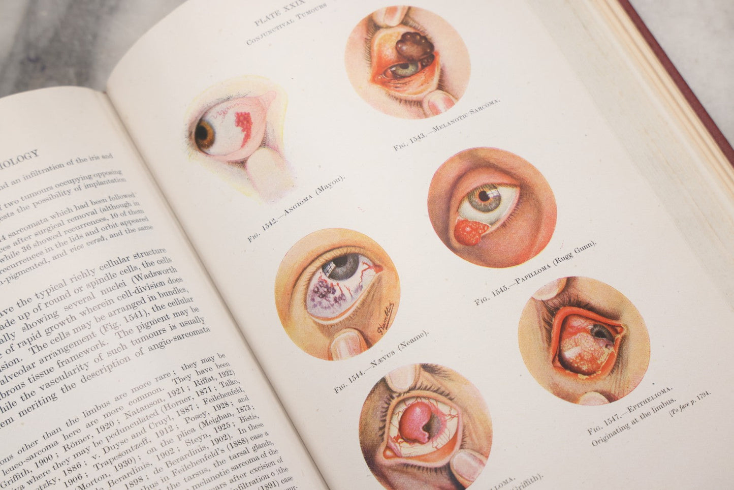 Lot 218 - "Text-Book Of Ophthalmology, Volume II" Vintage Illustrated Medical Reference By Sir W. Stewart Duke-Elder, The C. V. Mosby Company, 1944