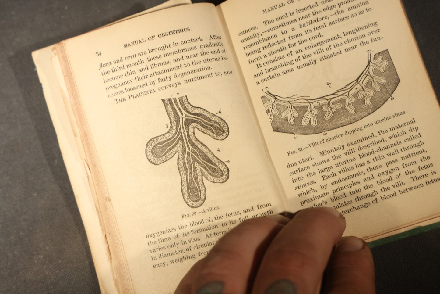 "A Manual of Obstetrics" Antique Illustrated Medical Book by Edward L. Partridge, M.D., Published by William Wood & Company, New York, 1884