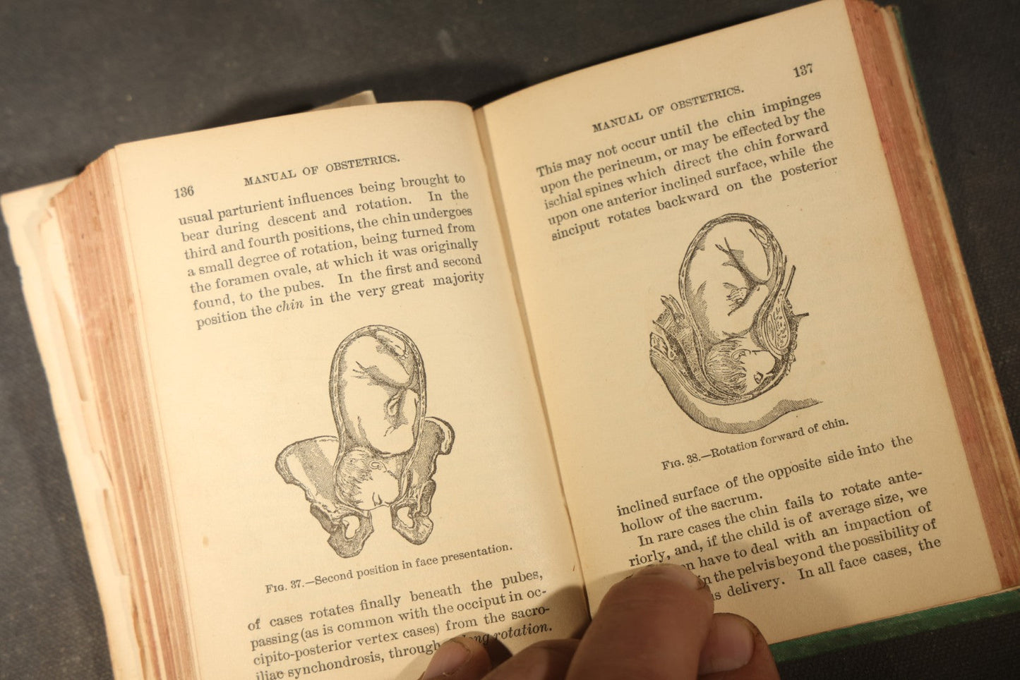 "A Manual of Obstetrics" Antique Illustrated Medical Book by Edward L. Partridge, M.D., Published by William Wood & Company, New York, 1884