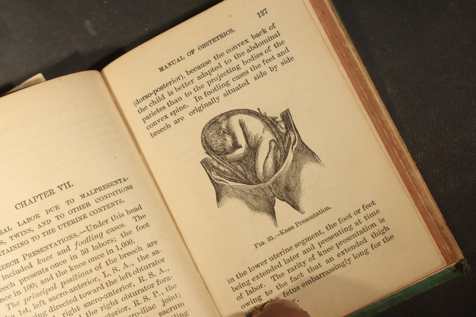 "A Manual of Obstetrics" Antique Illustrated Medical Book by Edward L. Partridge, M.D., Published by William Wood & Company, New York, 1884
