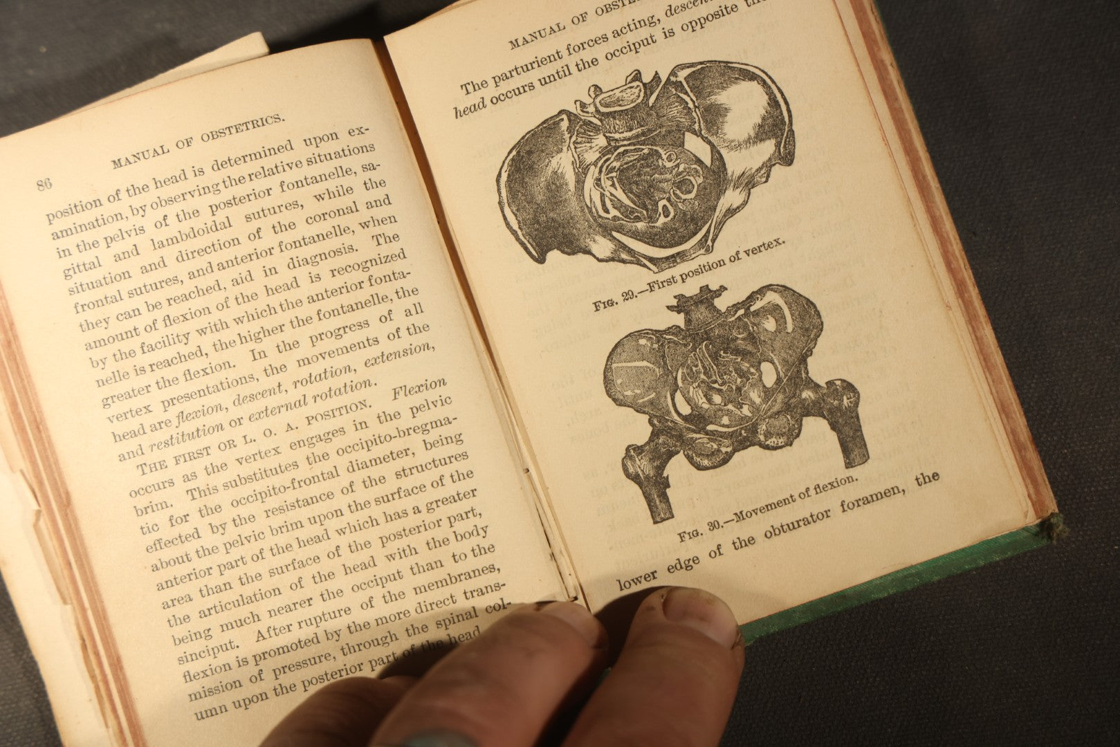 "A Manual of Obstetrics" Antique Illustrated Medical Book by Edward L. Partridge, M.D., Published by William Wood & Company, New York, 1884