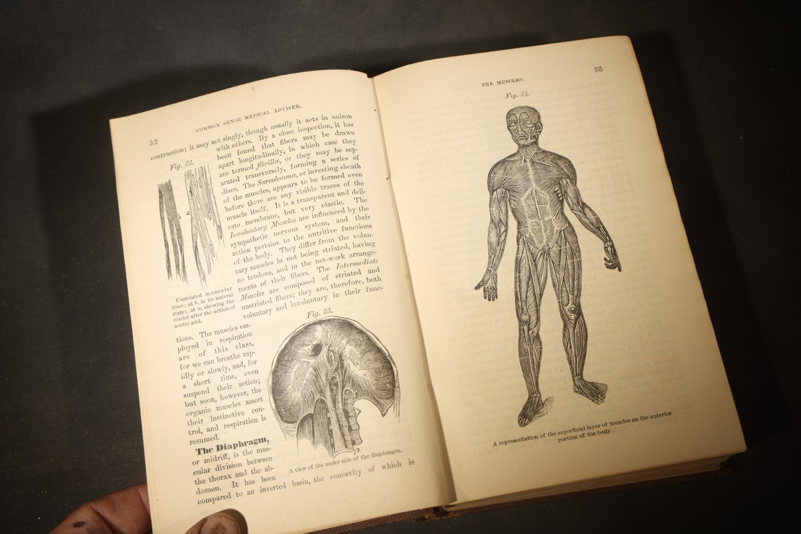 "The People's Common Sense Medical Adviser in Plain English; or, Medicine Simplified" Antique Medical Book with Anatomical Illustrations by R.V. Pierce, M.D., 18th Edition, Published by World's Dispensary Printing Office, Buffalo, New York, 1888
