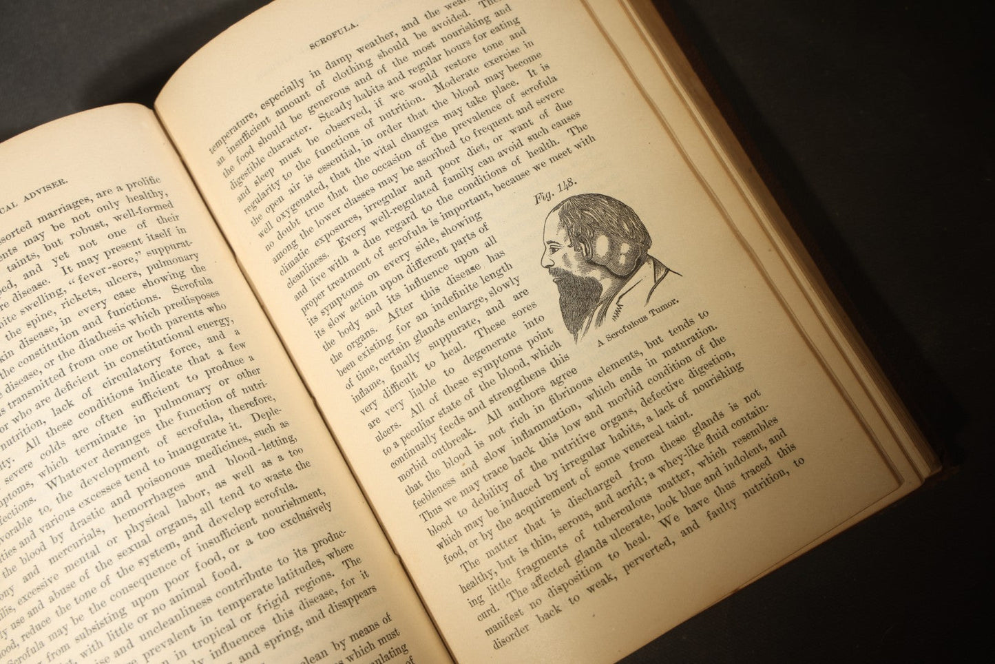 "The People's Common Sense Medical Adviser in Plain English; or, Medicine Simplified" Antique Medical Book with Anatomical Illustrations by R.V. Pierce, M.D., 18th Edition, Published by World's Dispensary Printing Office, Buffalo, New York, 1888