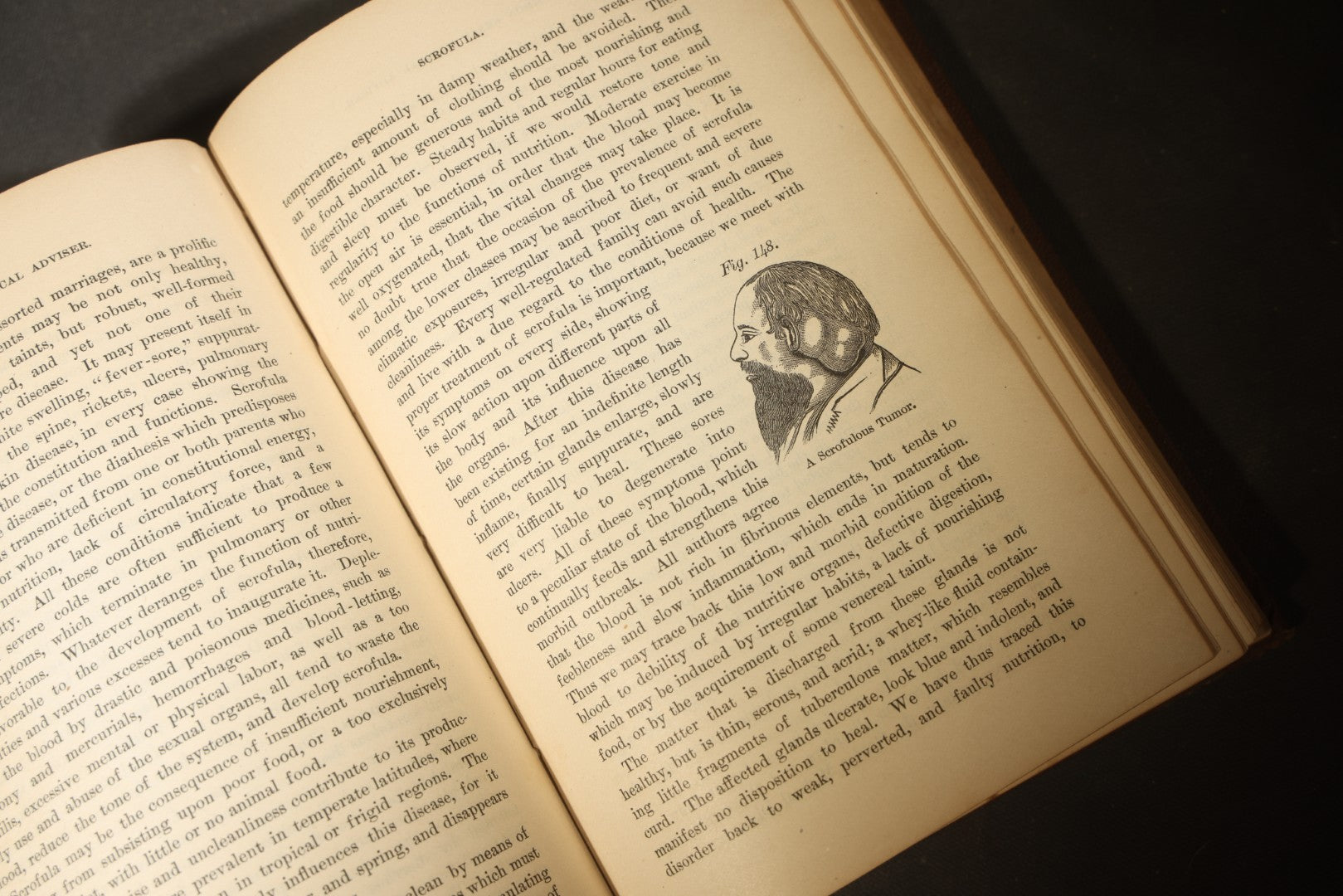 "The People's Common Sense Medical Adviser in Plain English; or, Medicine Simplified" Antique Medical Book with Anatomical Illustrations by R.V. Pierce, M.D., 18th Edition, Published by World's Dispensary Printing Office, Buffalo, New York, 1888