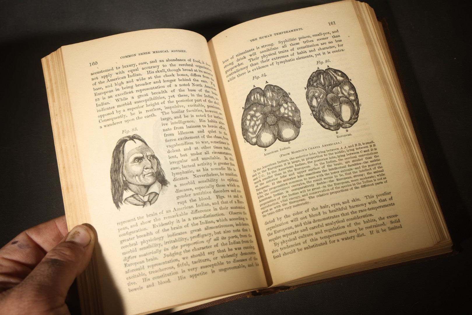 "The People's Common Sense Medical Adviser in Plain English; or, Medicine Simplified" Antique Medical Book with Anatomical Illustrations by R.V. Pierce, M.D., 18th Edition, Published by World's Dispensary Printing Office, Buffalo, New York, 1888