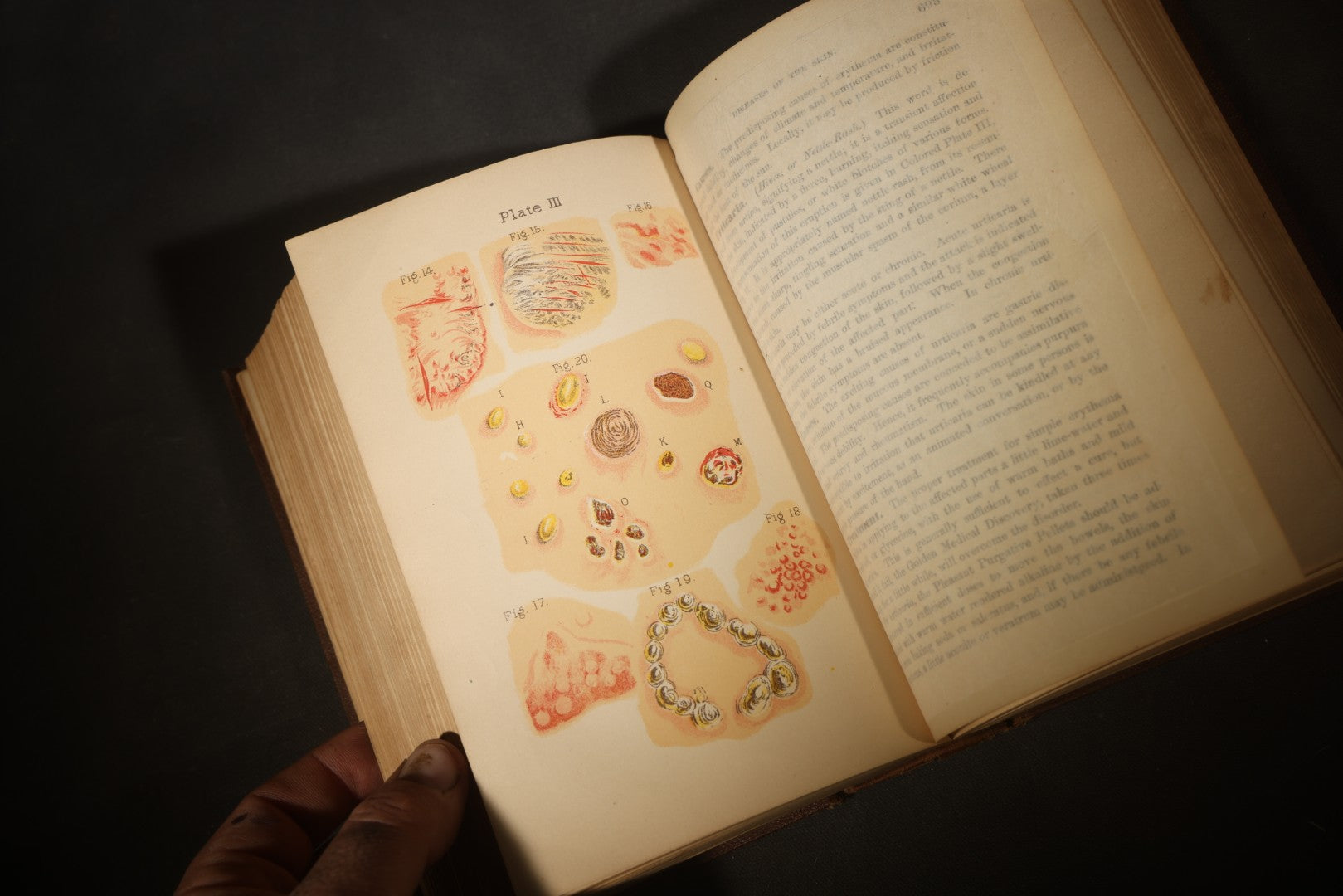 "The People's Common Sense Medical Adviser in Plain English; or, Medicine Simplified" Antique Medical Book with Anatomical Illustrations by R.V. Pierce, M.D., 18th Edition, Published by World's Dispensary Printing Office, Buffalo, New York, 1888