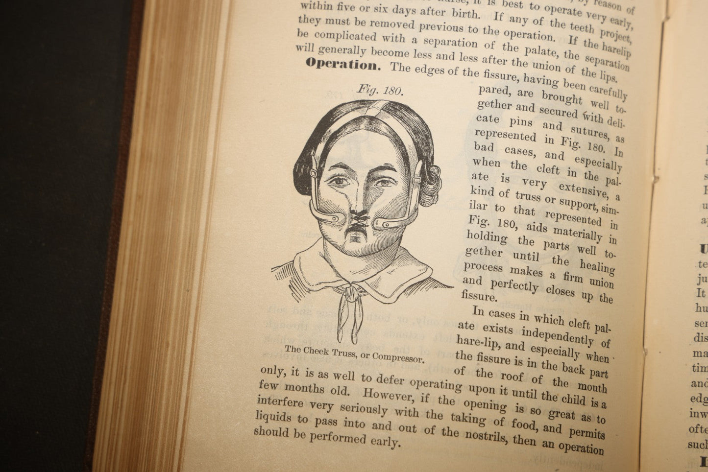 "The People's Common Sense Medical Adviser in Plain English; or, Medicine Simplified" Antique Medical Book with Anatomical Illustrations by R.V. Pierce, M.D., 18th Edition, Published by World's Dispensary Printing Office, Buffalo, New York, 1888