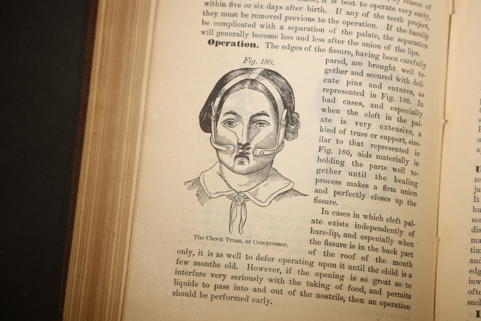 "The People's Common Sense Medical Adviser in Plain English; or, Medicine Simplified" Antique Medical Book with Anatomical Illustrations by R.V. Pierce, M.D., 18th Edition, Published by World's Dispensary Printing Office, Buffalo, New York, 1888