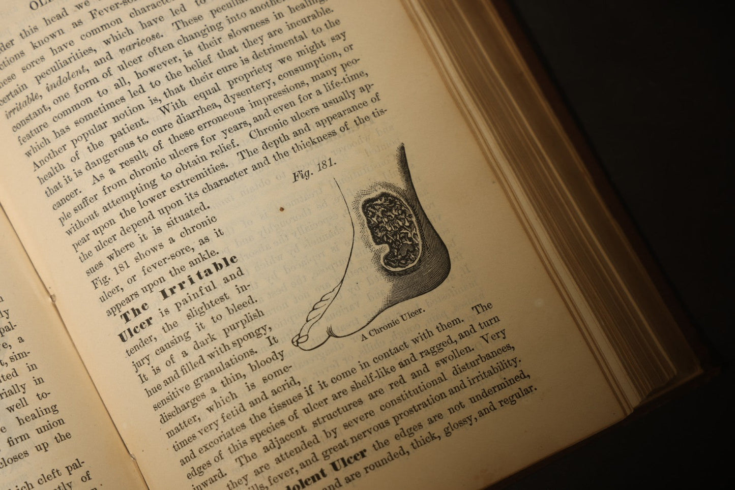 "The People's Common Sense Medical Adviser in Plain English; or, Medicine Simplified" Antique Medical Book with Anatomical Illustrations by R.V. Pierce, M.D., 18th Edition, Published by World's Dispensary Printing Office, Buffalo, New York, 1888