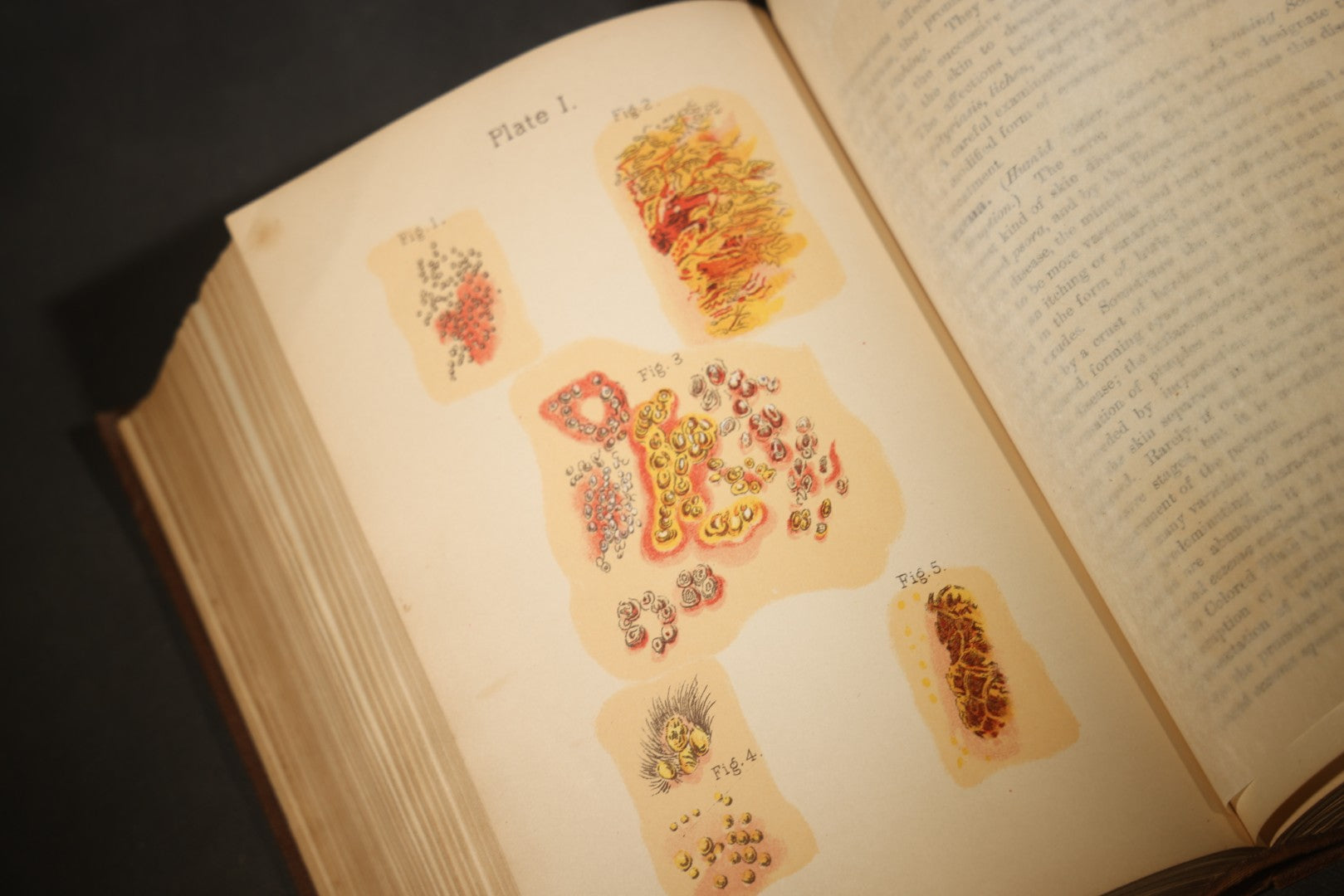 "The People's Common Sense Medical Adviser in Plain English; or, Medicine Simplified" Antique Medical Book with Anatomical Illustrations by R.V. Pierce, M.D., 18th Edition, Published by World's Dispensary Printing Office, Buffalo, New York, 1888