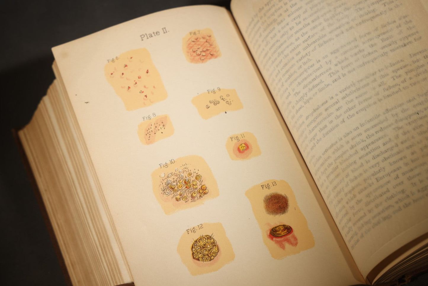 "The People's Common Sense Medical Adviser in Plain English; or, Medicine Simplified" Antique Medical Book with Anatomical Illustrations by R.V. Pierce, M.D., 18th Edition, Published by World's Dispensary Printing Office, Buffalo, New York, 1888
