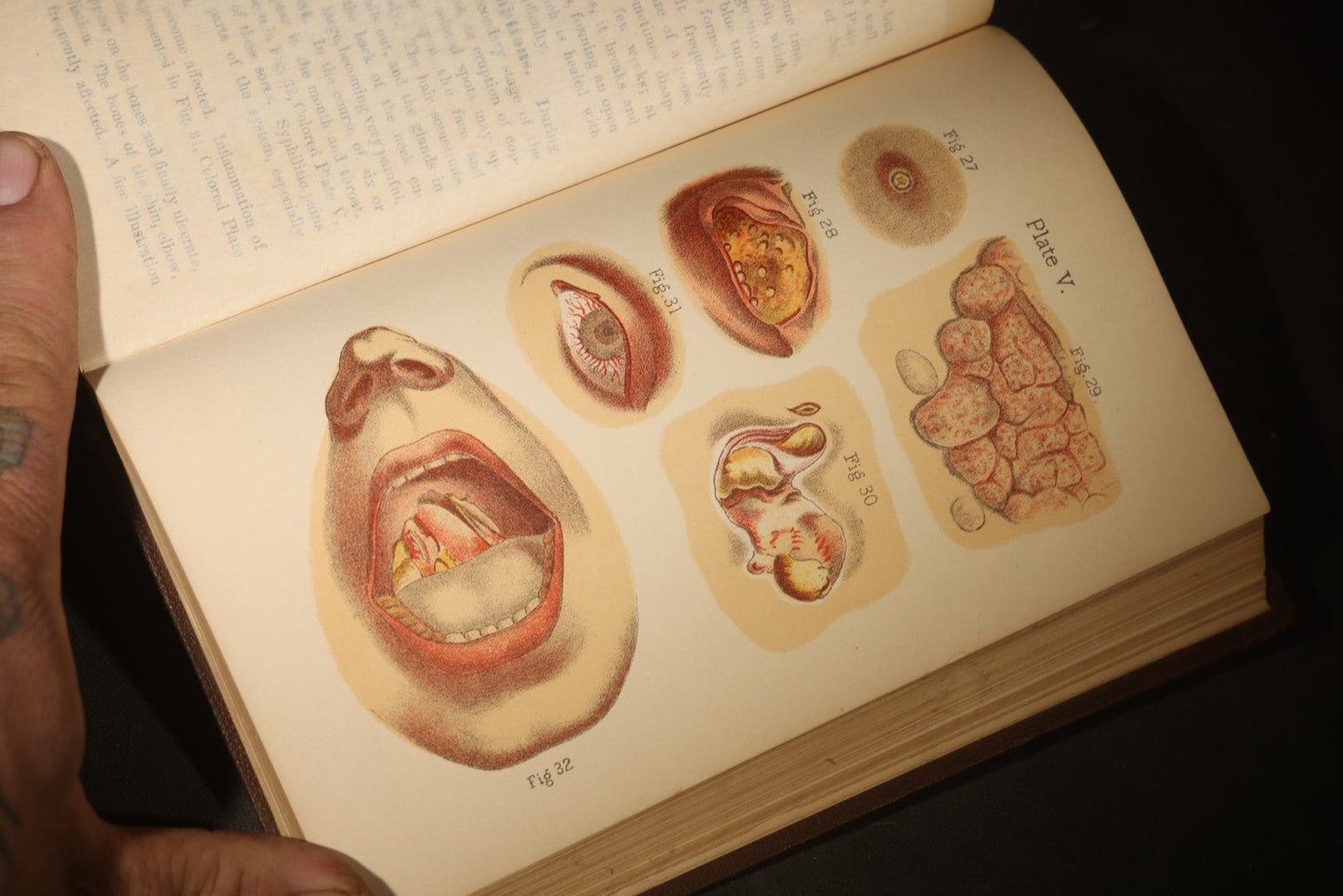 "The People's Common Sense Medical Adviser in Plain English; or, Medicine Simplified" Antique Medical Book with Anatomical Illustrations by R.V. Pierce, M.D., 18th Edition, Published by World's Dispensary Printing Office, Buffalo, New York, 1888