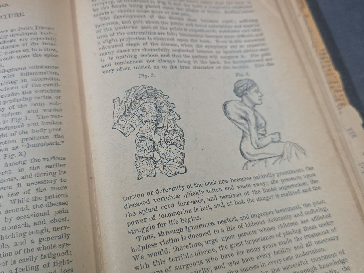 "The People's Common Sense Medical Adviser in Plain English" Antique Medical Book by R. V. Pierce, M.D., Fortieth Edition, Published by World's Dispensary Printing Office and Bindery, Buffalo, New York, 1885